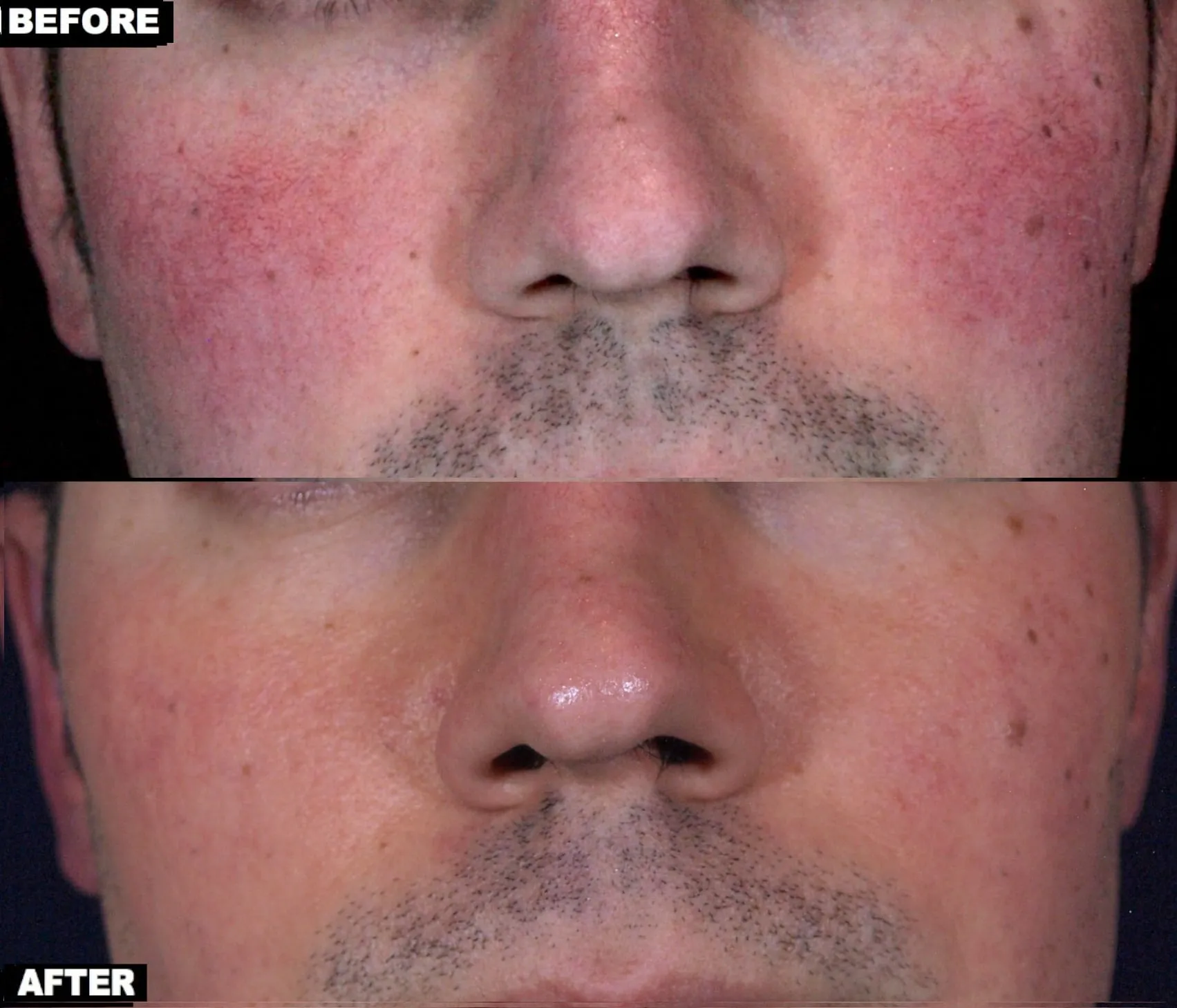 facial-redness-excel-v-and-v-beam-treatment